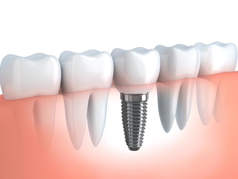 Dental Implants  Phoenix, AZ
