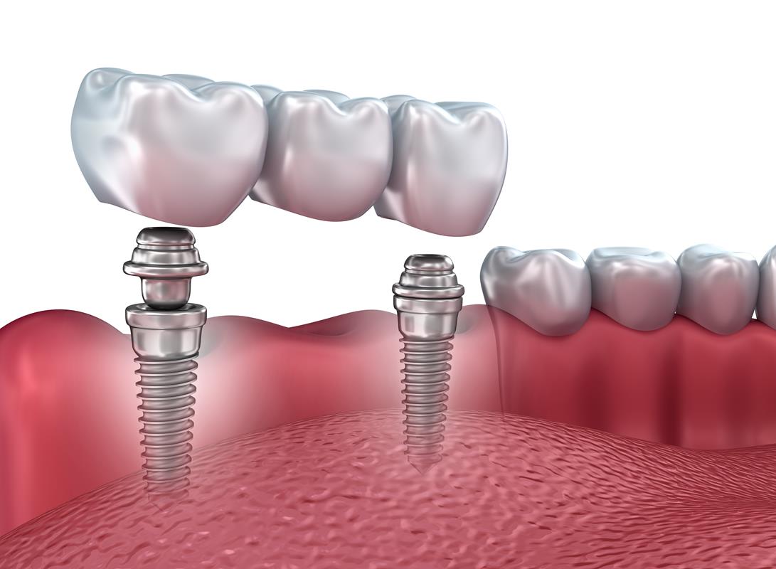 Dental Implants  Phoenix, AZ